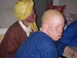 Association laments spate of skin cancer among albinos