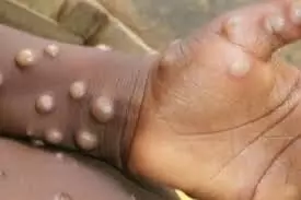 Edo records 3 suspected cases of Mpox-Official