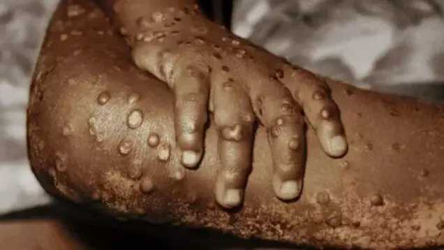 Rivers Govt. confirms 2 cases of monkeypox