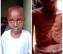 Kwankwaso sponsors treatment of malnourished boy