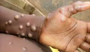 Mpox continues to pose threat as cases rise – Africa CDC